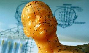 How to Find a Good Acupuncturist