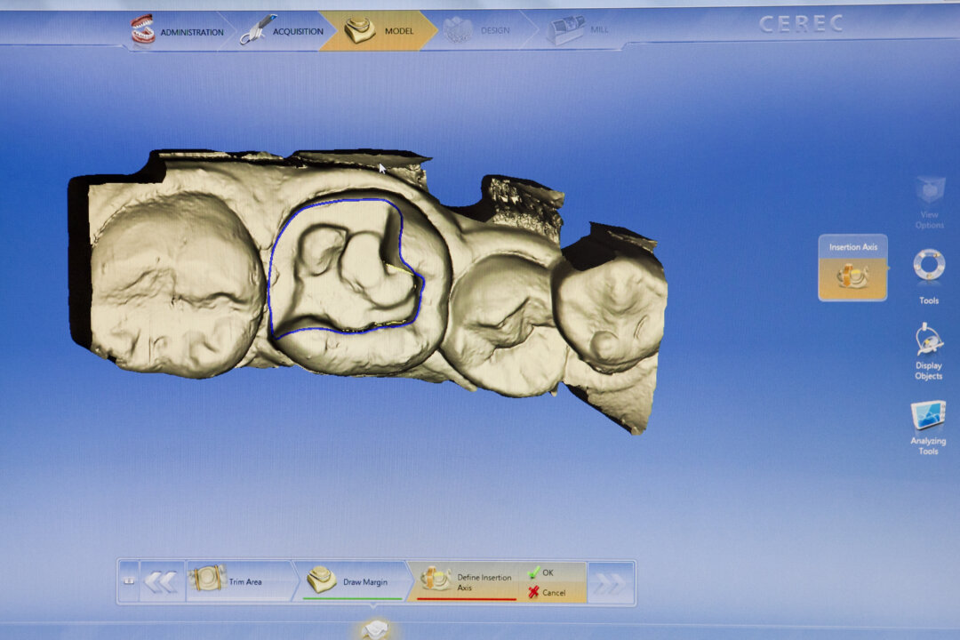 A scan shows the area of the tooth that will be replaced with a crown. Gallery 57 technicians are able to use this technology to fine tune the design of each crown to ensure best fit. (Samira Bouaou/The Epoch Times)