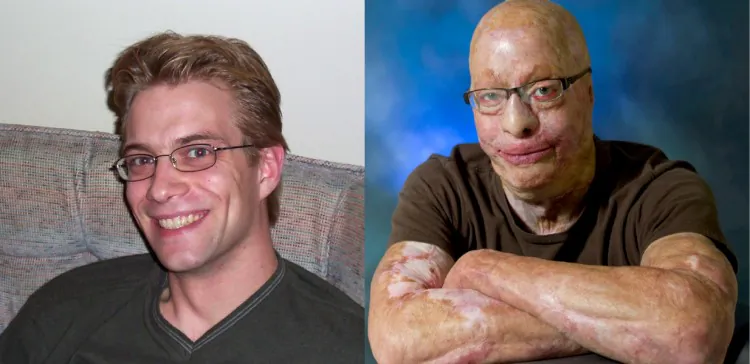 Spencer Beach pictured before and after the 2003 workplace accident that burned 90 percent of his body. (Courtesy Spencer Beach)
