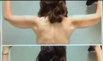 Arm Lift Surgery Got Popular Fast (+Photo)
