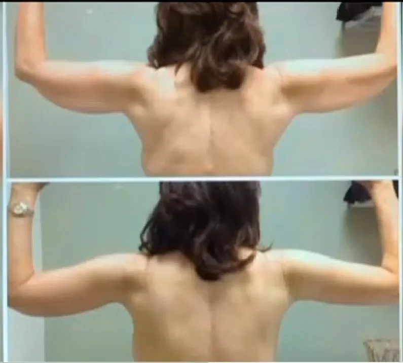 The difference before and after an upper arm lift surgery. (Screenshot/WCCO-TV)