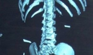 Doctor in China Removes Sewing Needles From Baby’s Body