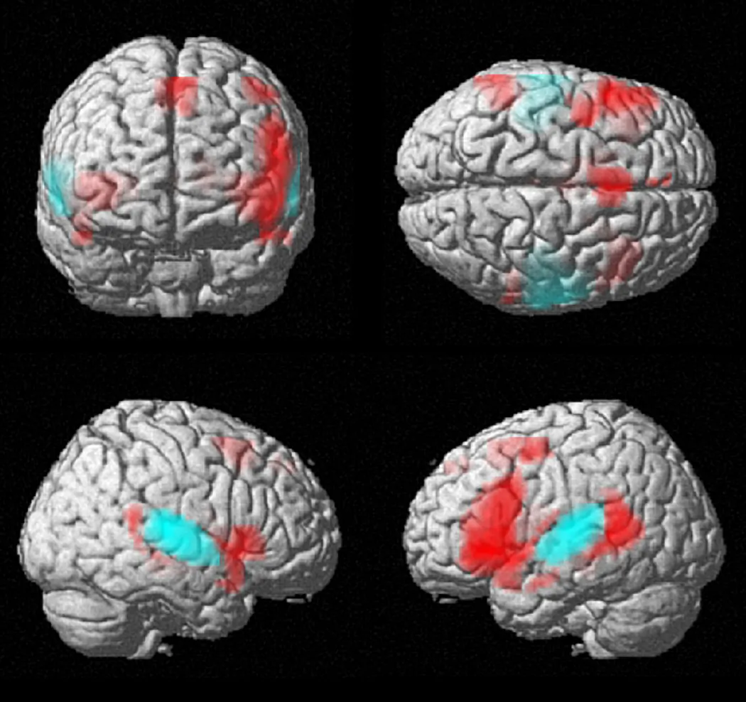The red shaded areas are regions of the brain that are active during speech and language. In more than 90 percent of individuals, language involves predominantly the left hemisphere of the brain. (University of Utah)
