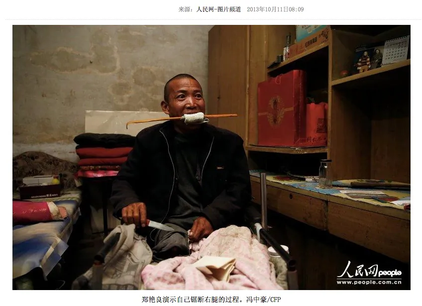 Screenshot showing Zheng Yanliang, who amputated his own leg after the pain from an incurable disease became too unbearable. (Screenshot/People's Daily)