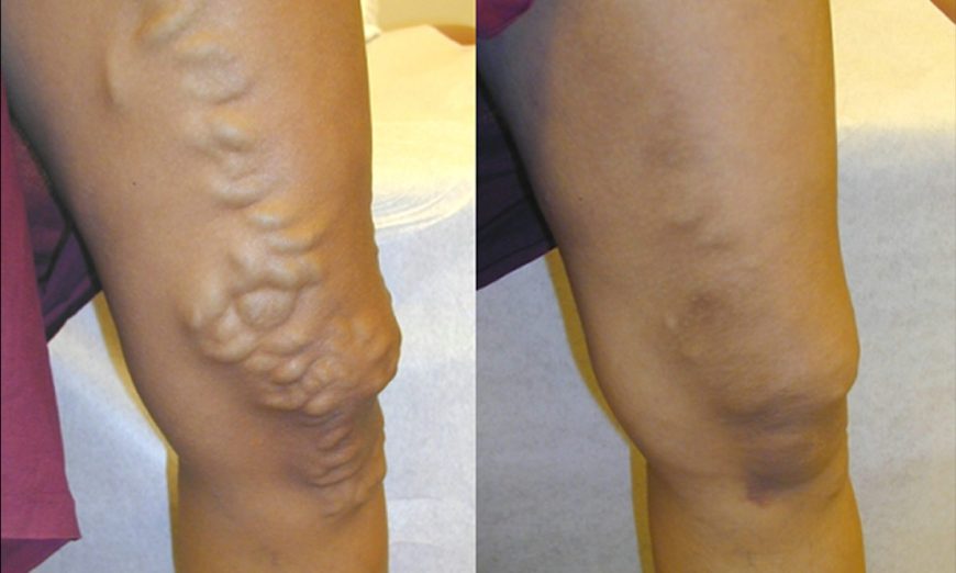 Varicose Veins Dangerous Without Treatment