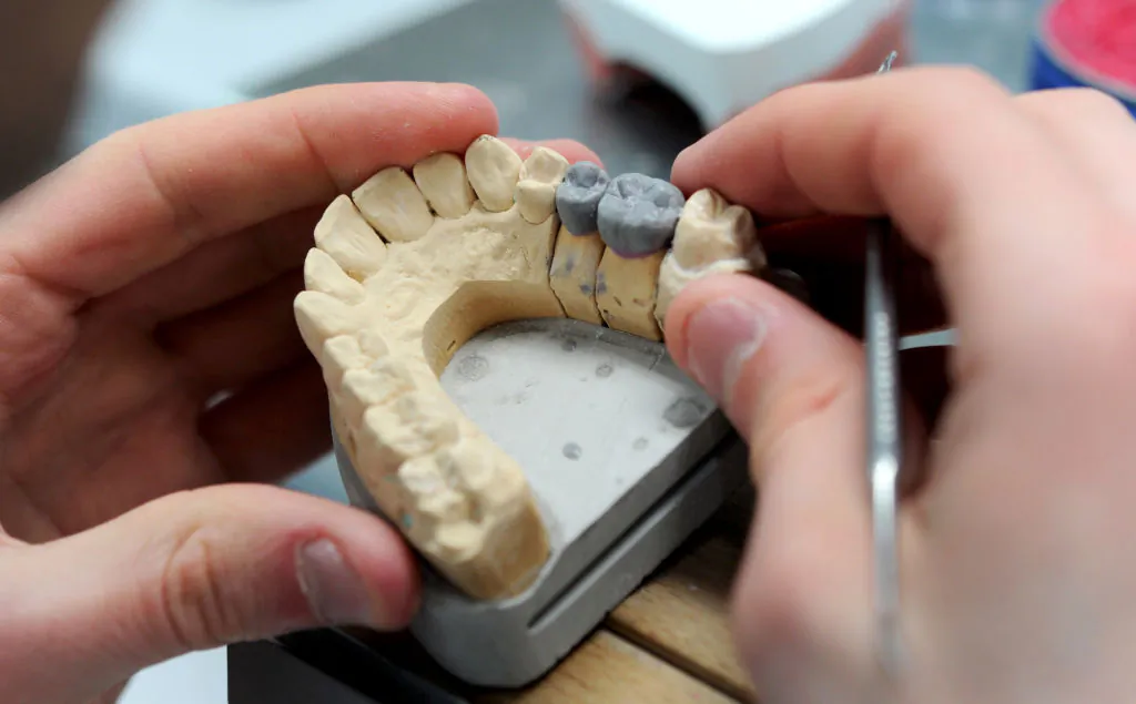 A dental prothesit works on a ceramic crown on March 14, 2017 in Saint-Evarzec, western France. (FRED TANNEAU/AFP/Getty Images)