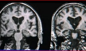 Women at Greater Risk for Alzheimer's (Video)