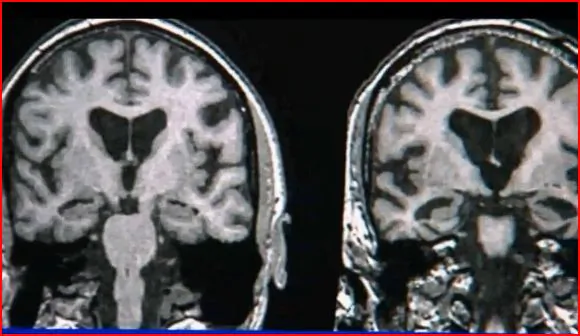 Women at Greater Risk for Alzheimer’s (Video)