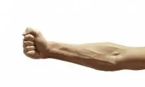 Health Check: What You Should Know About Varicose Veins