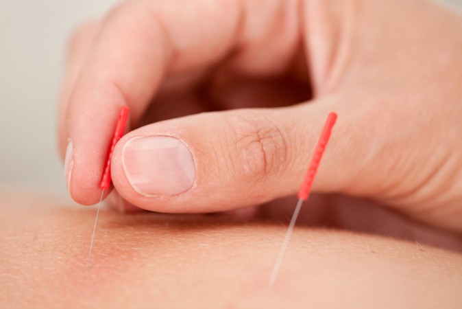 The Mysteries to Acupuncture Revealed