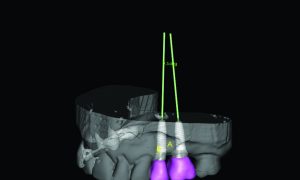 How Dental Implants Save Bone
