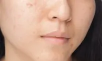 Why Do I Still Get Zits?