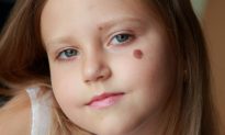 A Theory on How Birthmarks Could Correspond to Wounds From Past Lives