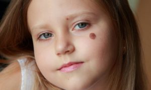 A Theory on How Birthmarks Could Correspond to Wounds From Past Lives