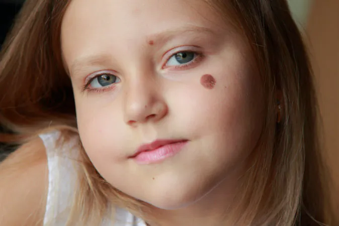 Could birthmarks be left by mental impressions from past lives? (Shutterstock*)