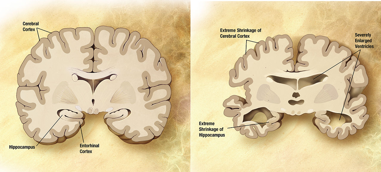 Alzheimer's Diseased Brain