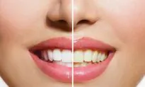 Top 5 Natural Tooth Whiteners