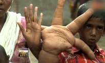 Indian Boy Is Born with 35-Pound Hands (Video)