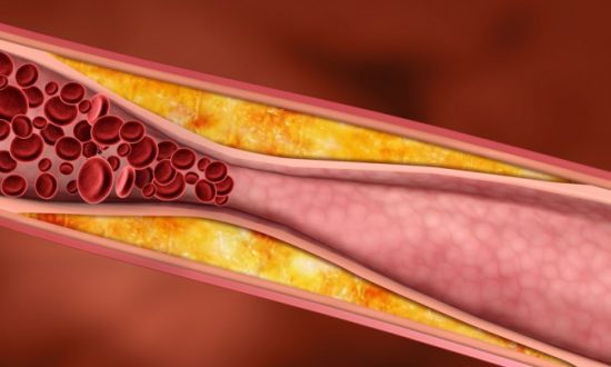 How To Clean Your Arteries With One Simple Fruit