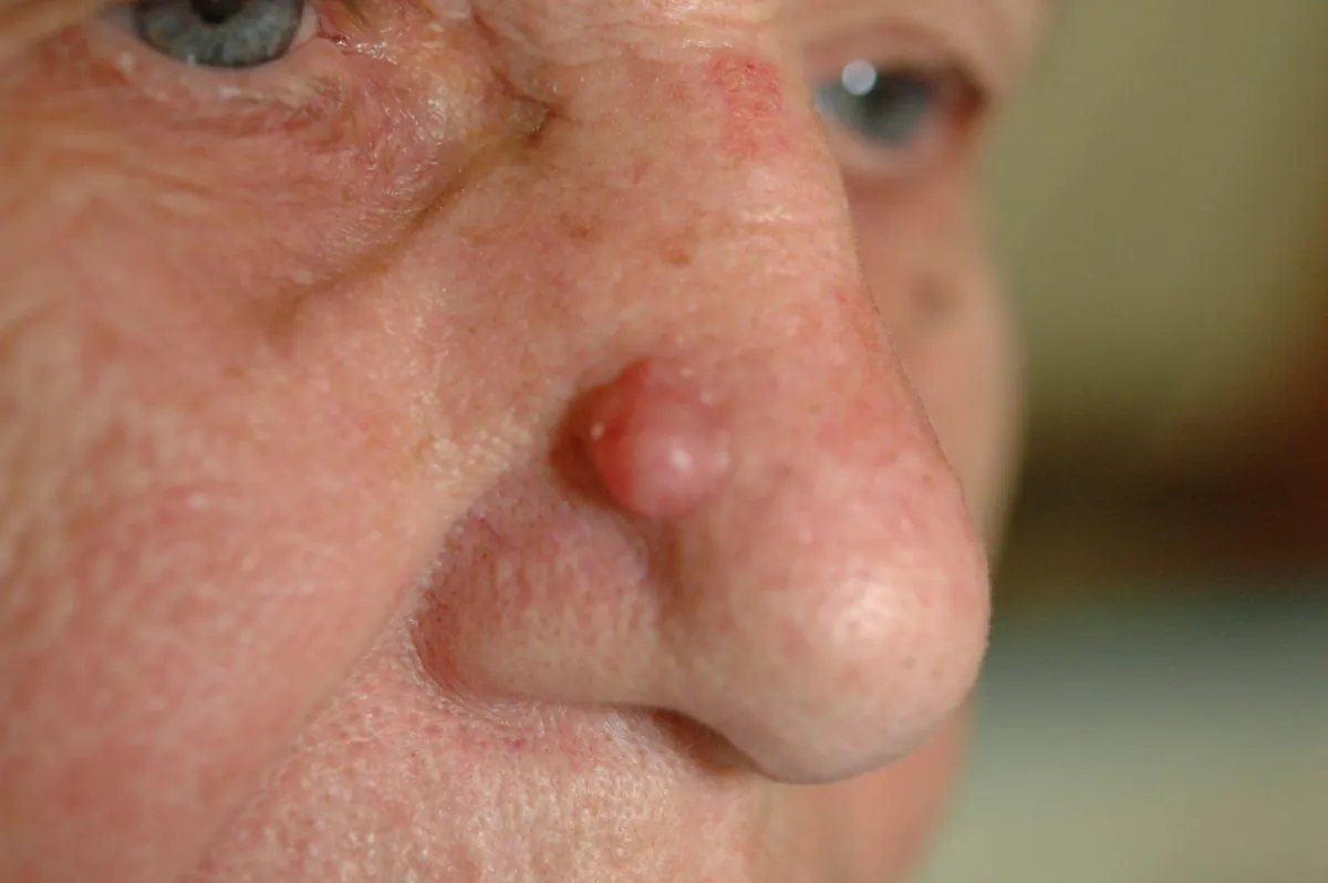 Basal cell skin cancer appears as raised bumps that are pink and waxy. (Courtesy of Dr. Michael Shapiro)