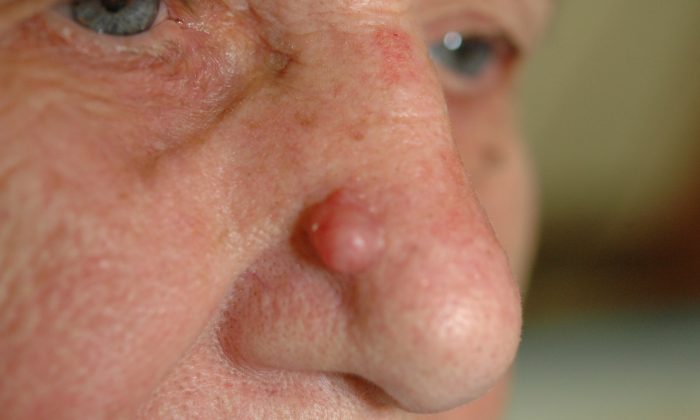 Basal cell skin cancer appears as raised bumps that are pink and waxy. (Courtesy of Dr. Michael Shapiro)