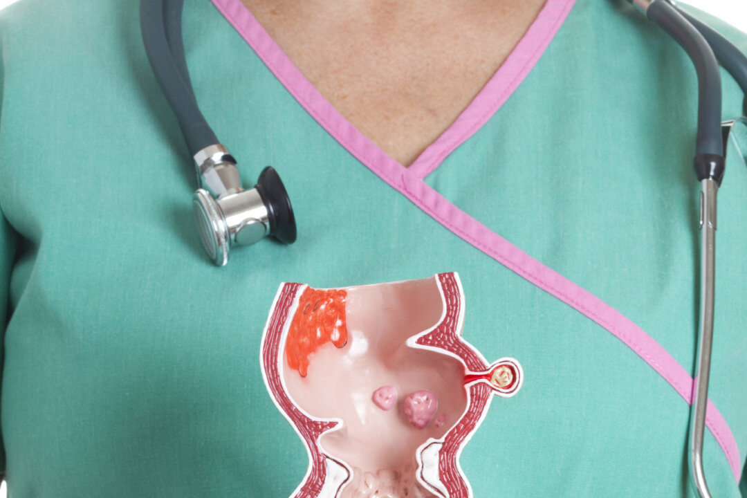 Colon cancer normally starts after a soft fleshy-like polyp forms in the large intestine. (ericsphotography/iStock/Thinkstock)