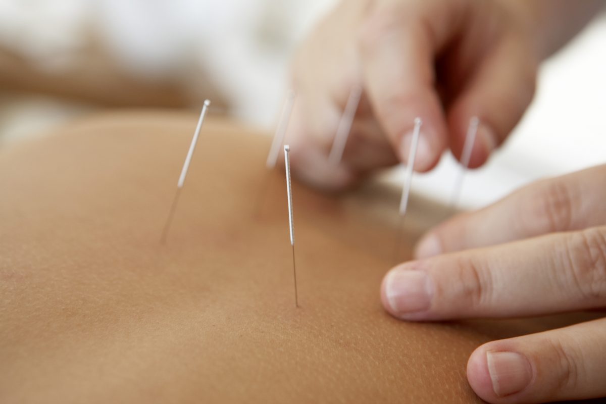 Acupuncture treats physical symptoms by treating imbalances in energetic systems. (BananaStock/BananaStock/Thinkstock)