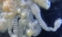 X-Ray Reveals Parasitic Worm Inside Man’s Foot (Video)
