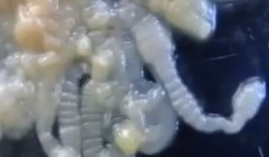 X-Ray Reveals Parasitic Worm Inside Man’s Foot (Video)