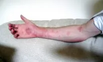 Natural Treatments for Hives