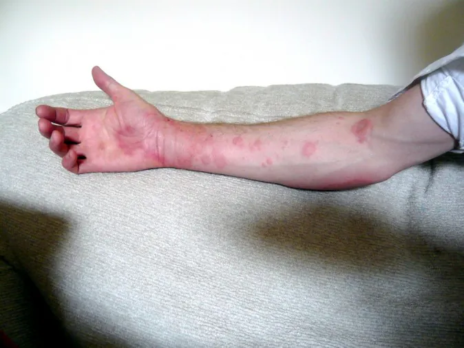 Urticaria (andy carter, CC BY 2.0)
