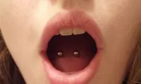 Tongue Piercings Cause GI Pain, Acupuncture Helps