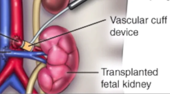 Will Americans Accept Organ Transplants From Aborted Fetuses?