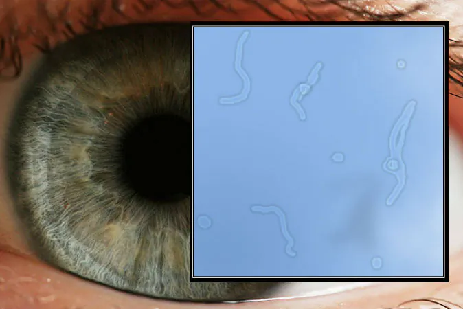 Eye (Petr Novák/Wikimedia Commons) Floaters (Wikimedia Commons)