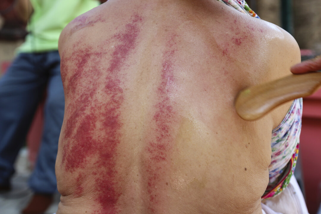 Ancient Technique Scrapes Away Pain