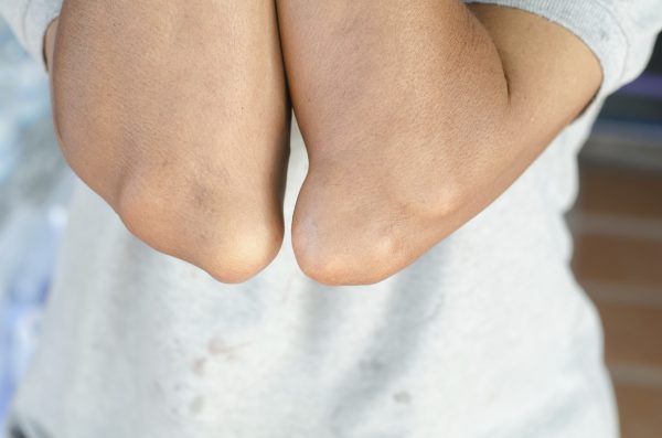 Elbow of patient with gout. Recent research has linked gout formation with elevated fructose consumption (joloei/iStock/Thinkstock)