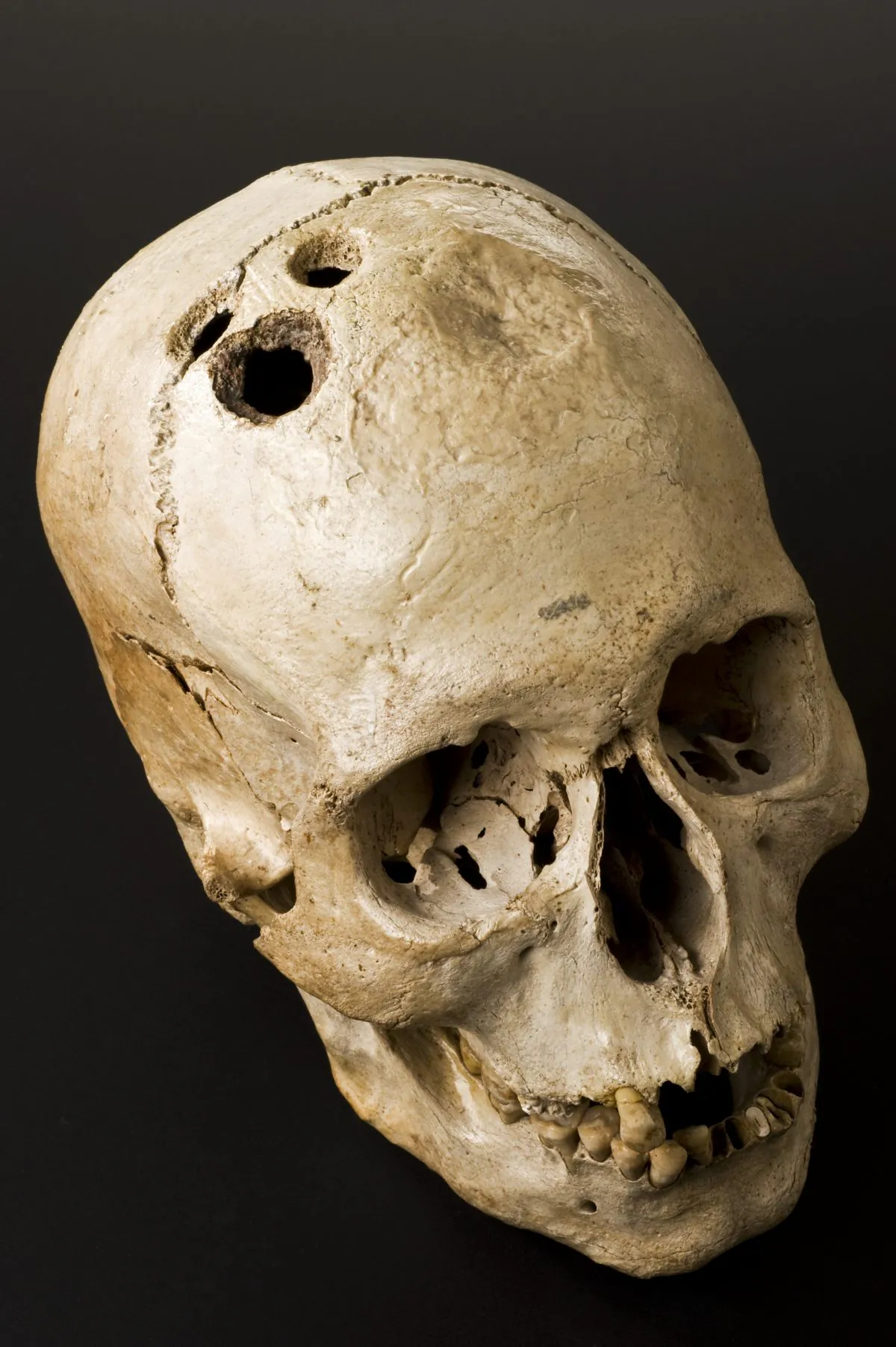 Bronze Age skull from Jericho, Palestine, 2200–2000 B.C. and an early example of trepanation, the oldest form of neurosurgery, which involves drilling into the skull. (Wellcome Images/CC BY 4.0/ Wikimedia Commons)
