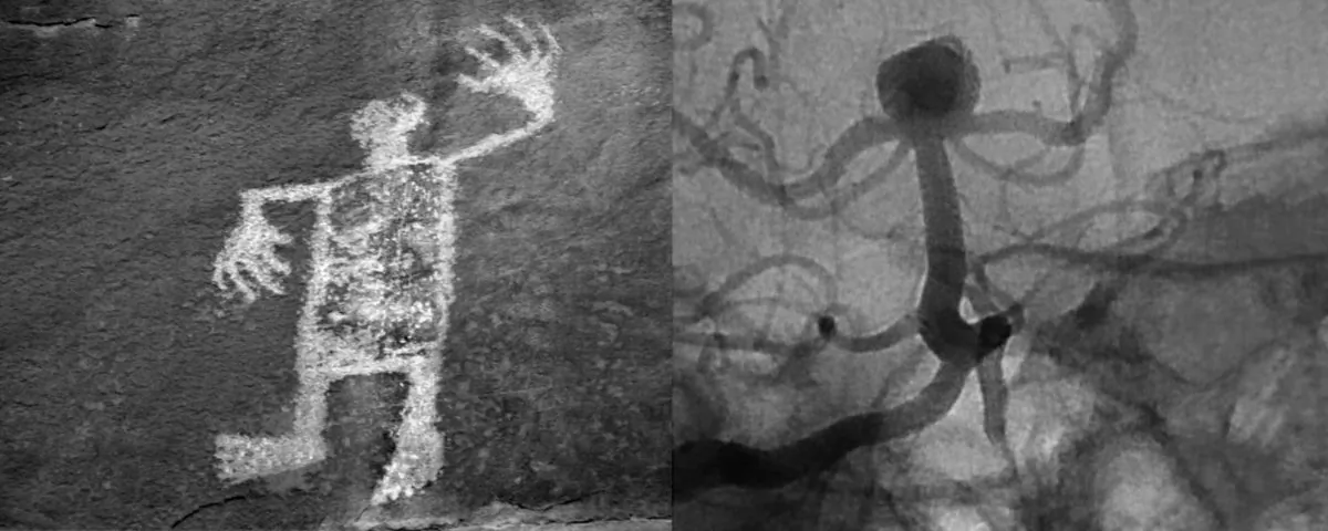 Petroglyph, Utah/Cerebral Aneurysm, Coiled (Caroline Tallmadge)
