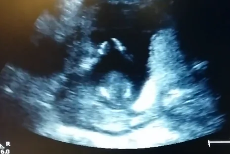 Ultrasound Baby Claps Along With Mother’s Song (Video)