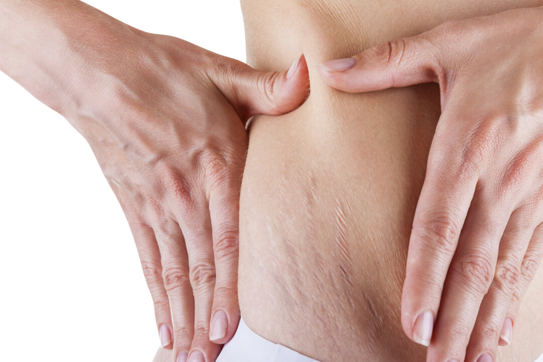 Stretch marks happen most frequently during adolescent or pregnancy growth. (Artem Furman/iStock)