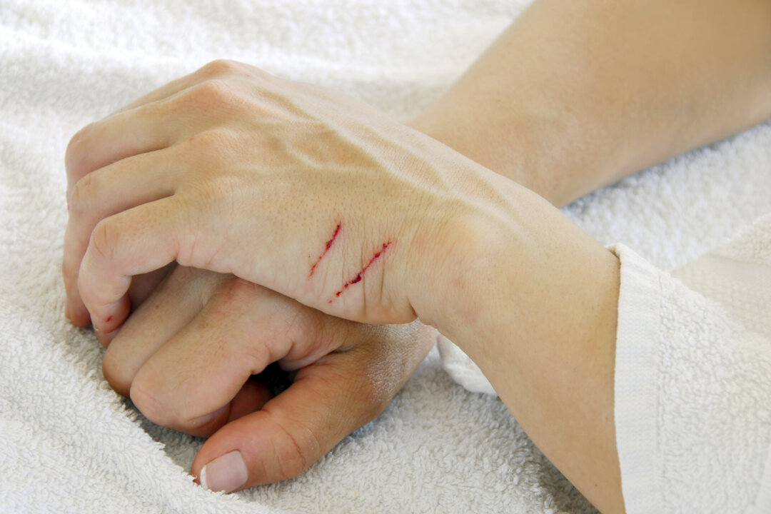 Scratched arms (simplytheyu/iStock)