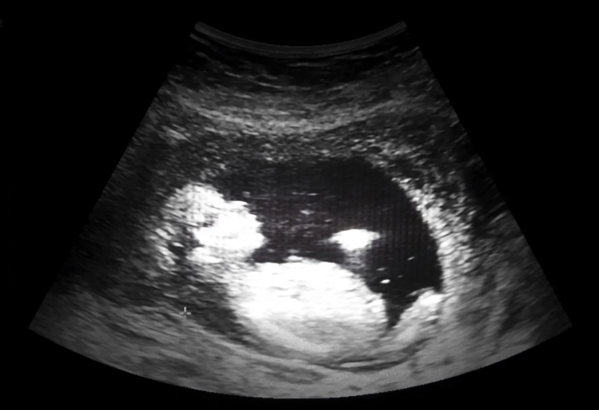 Ultrasound film of a thirteen week fetus. (Kornn Photo/iStock)