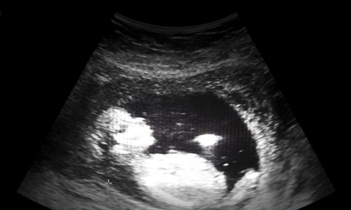 Ultrasound film of a thirteen week fetus. (Kornn Photo/iStock)
