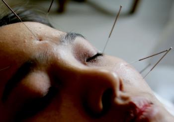 Acupuncture is an important part of Chinese medicine. (China Photos/Getty Images)