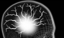 Magnetic Brain Stimulation May Aid Stroke Recovery