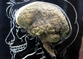 Carbs Are Bad News for the Brain