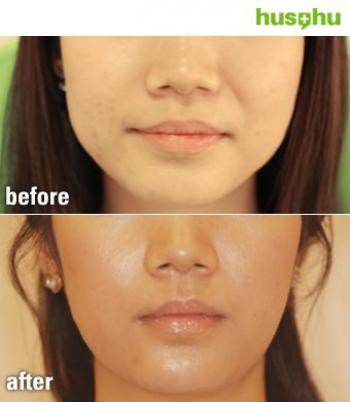 Botox (tm) treatment, before and after. (Courtesy Hus'Hu Clinic)
