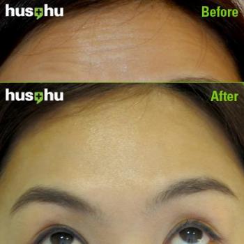 Botox (tm) treatment, before and after. (Courtesy Hus'Hu Clinic)