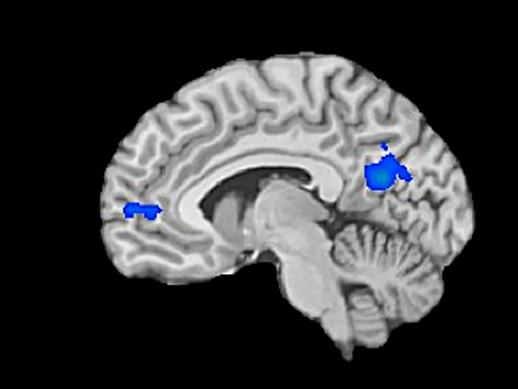 The areas shaded in blue highlight areas of decreased activity in the brains of meditators. (Yale University)