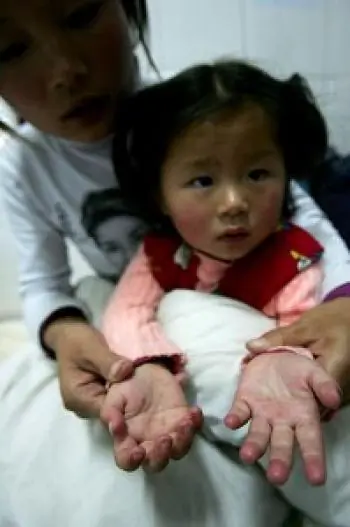 China’s Ministry of Health reported that there are currently 41,846 cases of hand, foot and mouth disease (HFMD) in 30 provinces and regions. (The Epoch Times)